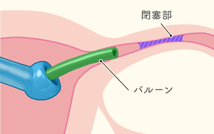 卵管通気検査、卵管通水検査
