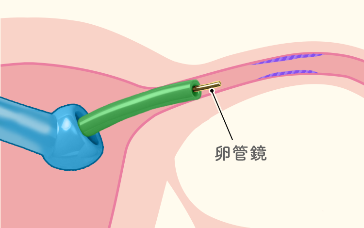卵管通気検査、卵管通水検査